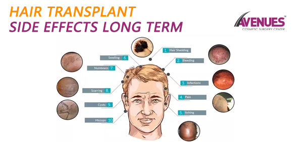 Hair transplant side effects: The 8 unpleasant symptoms you might  experience - Express.co.uk